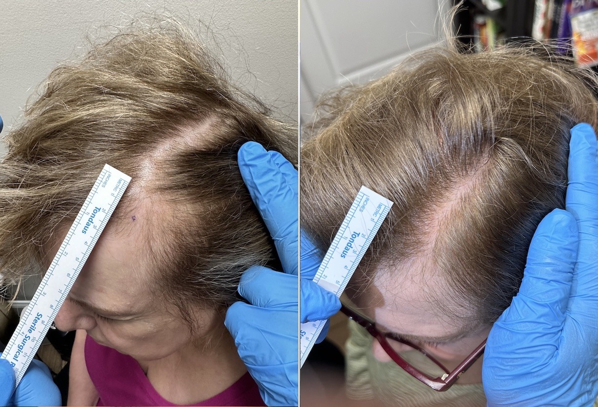Hair Loss Solutions for Women in Ortonville, MI