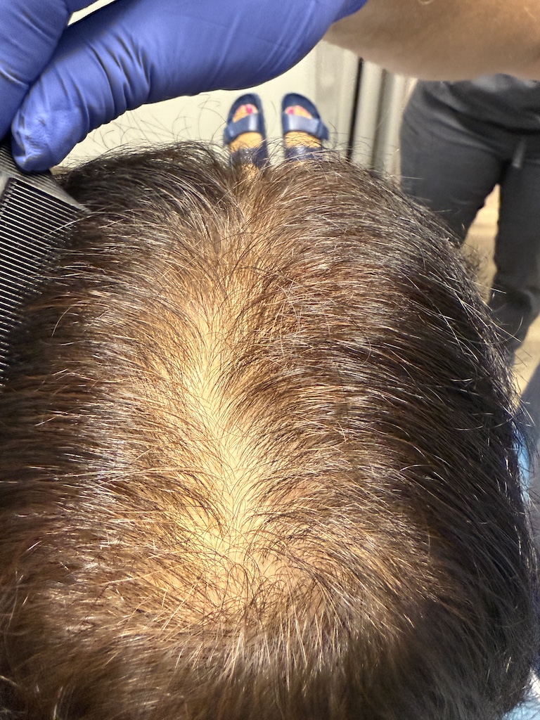 women’s hair thinning treatment, treating women’s thinning hair, doctors that treat thinning hair, women’s hair loss clinics, restoring hair growth, Restoring hair loss in women, restoring women’s hair loss