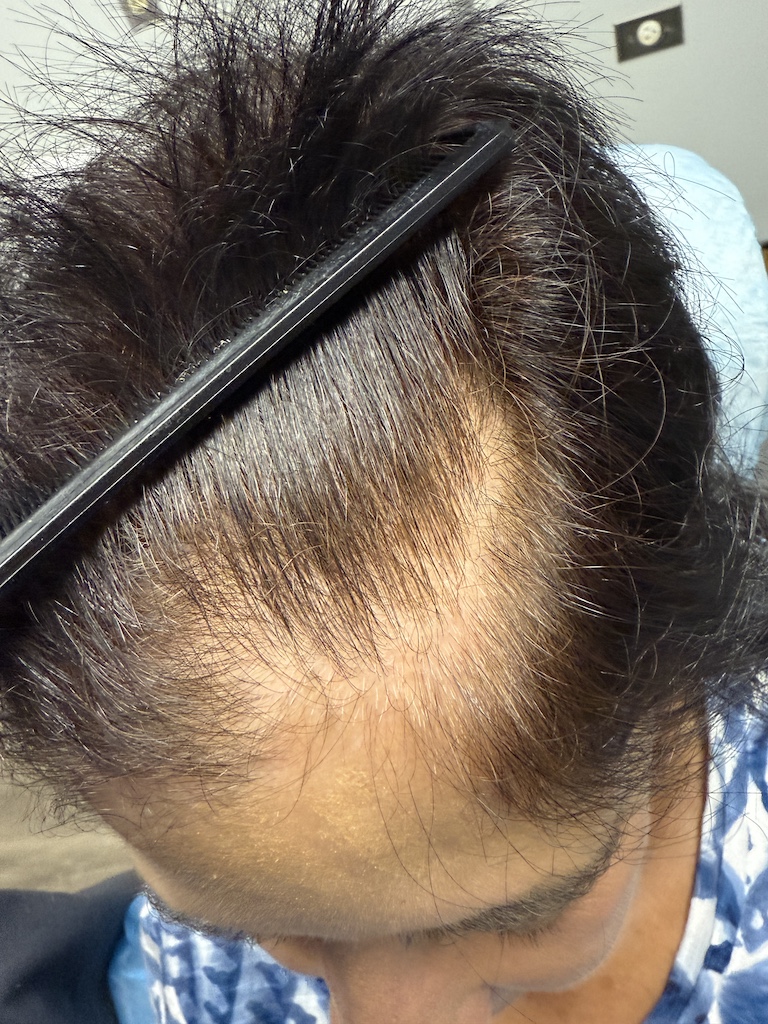 women’s hair thinning treatment, treating women’s thinning hair, doctors that treat thinning hair, women’s hair loss clinics, restoring hair growth, Restoring hair loss in women, restoring women’s hair loss