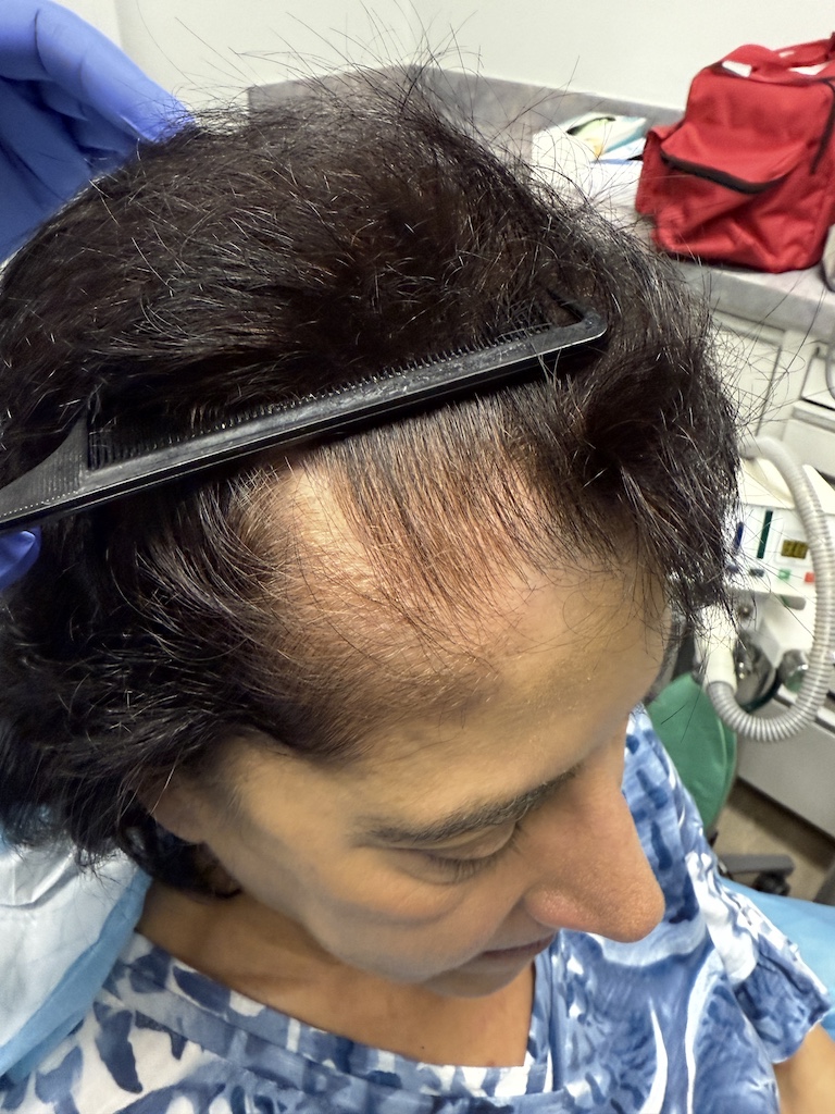 women’s hair thinning treatment, treating women’s thinning hair, doctors that treat thinning hair, women’s hair loss clinics, restoring hair growth, Restoring hair loss in women, restoring women’s hair loss