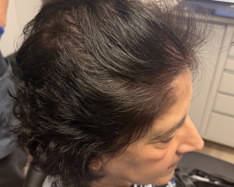 Women’s Hair Loss Clinic, Hair Loss Clinics Near Me, Hair Loss Clinic Naples, Hair Loss Clinic Fort Myers, , Hair Restoration Clinics in Naples, Hair Restoration Clinics in Fort Myers, Hair loss clinics near me, Women’s Hair Thinning Treatment, Doctors that treat thinning hair, Dermatologists that treat thinning hair, Hair Regrowth Clinics Near Me, Womens Hair growth Treatment, Doctors that restore hair growth, Hair Growth Clinics, women’s hair restoration, doctors that restore hair growth, doctors that specialize in hair restoration, non surgical hair restoration treatment, women’s hair restoration treatment, women’s hair restoration near me, Alopecia Dermatologist Near Me, Trichologist Near Me, Trichologist Naples Florida, Women’s Hair Restoration Clinics Near Me, Women’s Hair Restoration Near Me, Naples Hair Restoration, Fort Myers Hair Restoration, PRP Hair Restoration, prp for hair, PBC Hair Restoration, prp hair loss, PBC hair restoration treatment, platelet rich plasma for hair loss, prp hair loss treatment, Regenerative Hair Restoration, Regenerative Hair Growth, Regenerative Hair Regrowth, Naples Hair Loss Treatment, Fort Myers Hair Loss Treatment, Non-surgical hair loss treatment, Non-surgical hair growth treatment, Women’s hair growth treatment, Non-surgical hair regrowth treatment, Women’s hair regrowth treatment, Female hair growth treatment, Best hair growth treatment for women, hair thinning treatment for female, best treatment for hair growth, best non surgical hair loss treatment, Treating androgenic alopecia