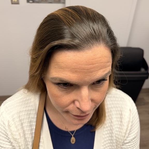 women’s hair thinning treatment, treating women’s thinning hair, doctors that treat thinning hair, women’s hair loss clinics, restoring hair growth, Restoring hair loss in women, restoring women’s hair loss