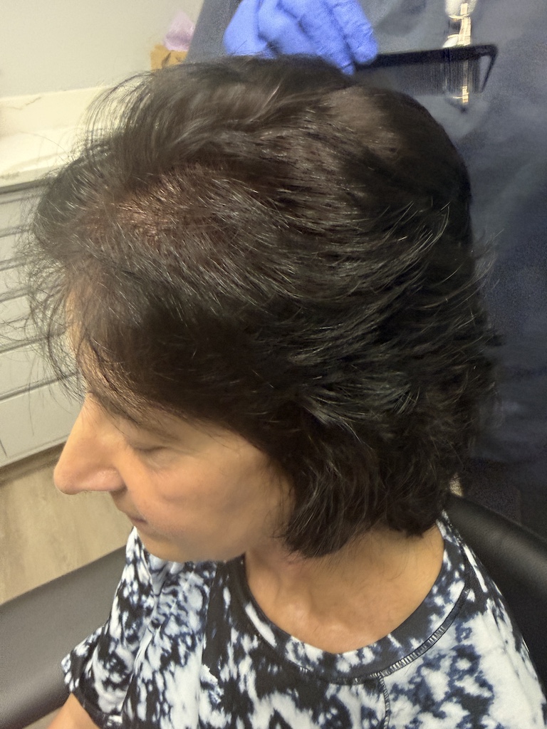 women’s hair thinning treatment, treating women’s thinning hair, doctors that treat thinning hair, women’s hair loss clinics, restoring hair growth, Restoring hair loss in women, restoring women’s hair loss