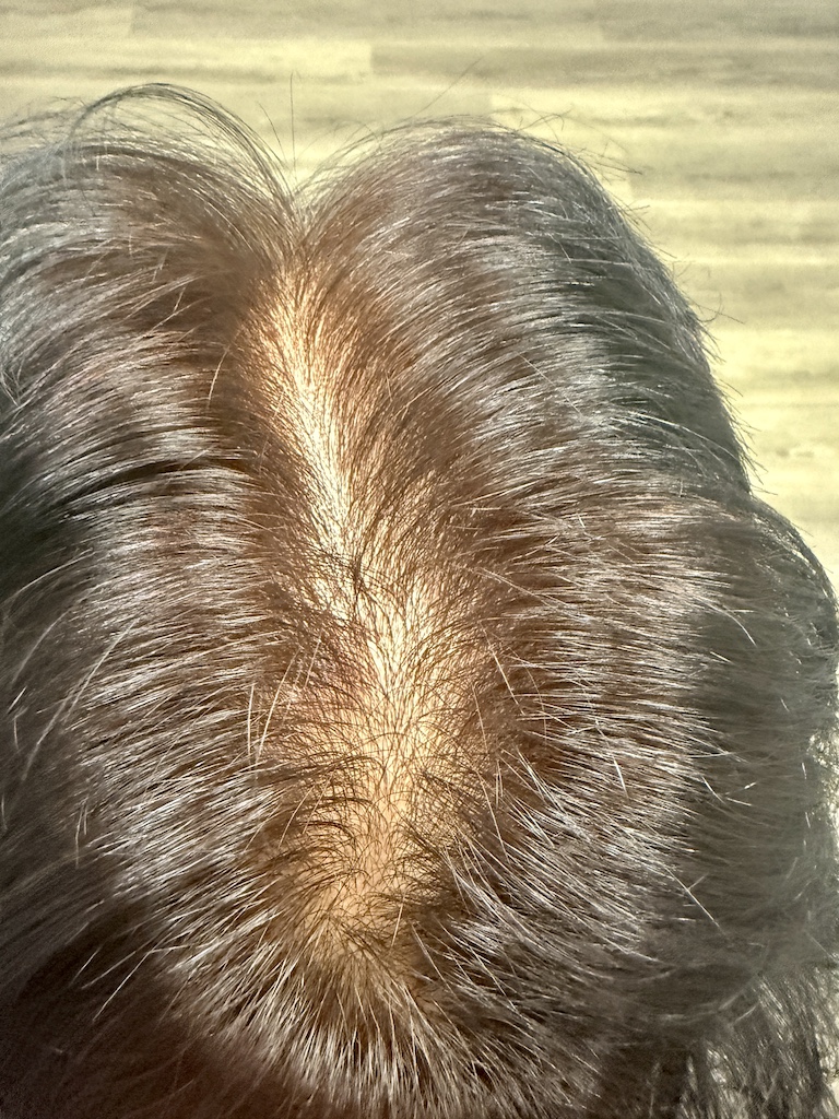 women’s hair thinning treatment, treating women’s thinning hair, doctors that treat thinning hair, women’s hair loss clinics, restoring hair growth, Restoring hair loss in women, restoring women’s hair loss