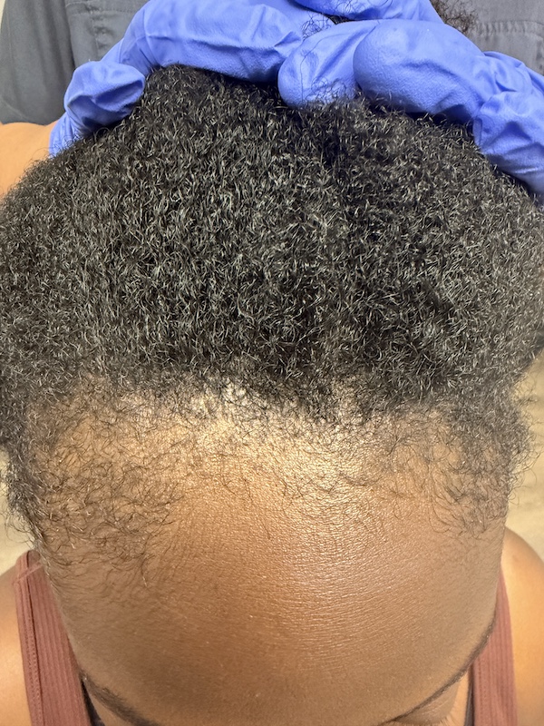 Women’s Hair Loss Clinic, Hair Loss Clinics Near Me, Hair Loss Clinic Naples, Hair Loss Clinic Fort Myers, , Hair Restoration Clinics in Naples, Hair Restoration Clinics in Fort Myers, Hair loss clinics near me, Women’s Hair Thinning Treatment, Doctors that treat thinning hair, Dermatologists that treat thinning hair, Hair Regrowth Clinics Near Me, Womens Hair growth Treatment, Doctors that restore hair growth, Hair Growth Clinics, women’s hair restoration, doctors that restore hair growth, doctors that specialize in hair restoration, non surgical hair restoration treatment, women’s hair restoration treatment, women’s hair restoration near me, Alopecia Dermatologist Near Me, Trichologist Near Me, Trichologist Naples Florida, Women’s Hair Restoration Clinics Near Me, Women’s Hair Restoration Near Me, Naples Hair Restoration, Fort Myers Hair Restoration, PRP Hair Restoration, prp for hair, PBC Hair Restoration, prp hair loss, PBC hair restoration treatment, platelet rich plasma for hair loss, prp hair loss treatment, Regenerative Hair Restoration, Regenerative Hair Growth, Regenerative Hair Regrowth, Naples Hair Loss Treatment, Fort Myers Hair Loss Treatment, Non-surgical hair loss treatment, Non-surgical hair growth treatment, Women’s hair growth treatment, Non-surgical hair regrowth treatment, Women’s hair regrowth treatment, Female hair growth treatment, Best hair growth treatment for women, hair thinning treatment for female, best treatment for hair growth, best non surgical hair loss treatment, Treating androgenic alopecia