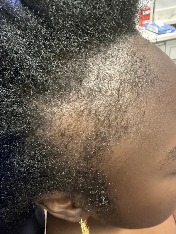 Women’s Hair Loss Clinic, Hair Loss Clinics Near Me, Hair Loss Clinic Naples, Hair Loss Clinic Fort Myers, , Hair Restoration Clinics in Naples, Hair Restoration Clinics in Fort Myers, Hair loss clinics near me, Women’s Hair Thinning Treatment, Doctors that treat thinning hair, Dermatologists that treat thinning hair, Hair Regrowth Clinics Near Me, Womens Hair growth Treatment, Doctors that restore hair growth, Hair Growth Clinics, women’s hair restoration, doctors that restore hair growth, doctors that specialize in hair restoration, non surgical hair restoration treatment, women’s hair restoration treatment, women’s hair restoration near me, Alopecia Dermatologist Near Me, Trichologist Near Me, Trichologist Naples Florida, Women’s Hair Restoration Clinics Near Me, Women’s Hair Restoration Near Me, Naples Hair Restoration, Fort Myers Hair Restoration, PRP Hair Restoration, prp for hair, PBC Hair Restoration, prp hair loss, PBC hair restoration treatment, platelet rich plasma for hair loss, prp hair loss treatment, Regenerative Hair Restoration, Regenerative Hair Growth, Regenerative Hair Regrowth, Naples Hair Loss Treatment, Fort Myers Hair Loss Treatment, Non-surgical hair loss treatment, Non-surgical hair growth treatment, Women’s hair growth treatment, Non-surgical hair regrowth treatment, Women’s hair regrowth treatment, Female hair growth treatment, Best hair growth treatment for women, hair thinning treatment for female, best treatment for hair growth, best non surgical hair loss treatment, Treating androgenic alopecia