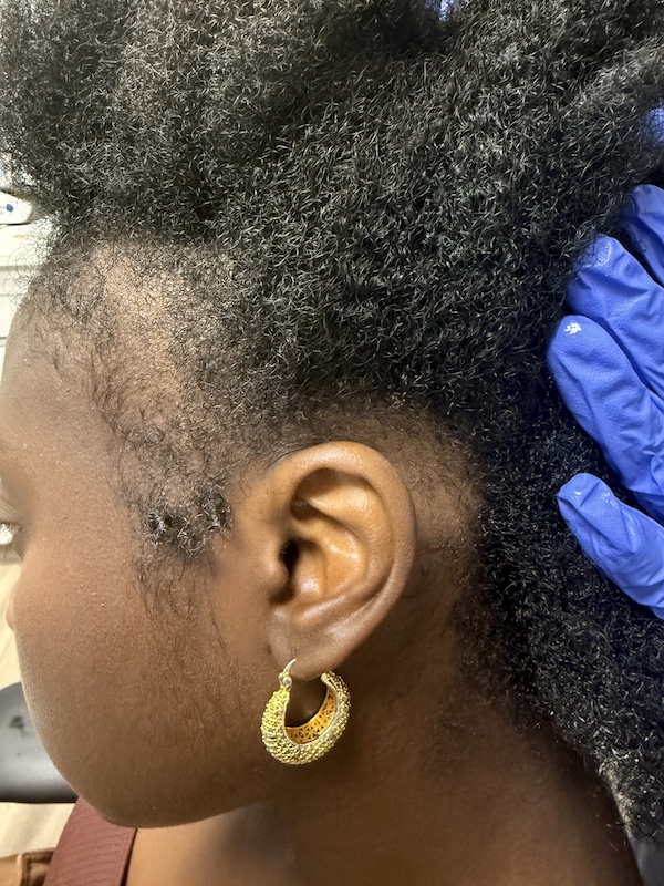 Women’s Hair Loss Clinic, Hair Loss Clinics Near Me, Hair Loss Clinic Naples, Hair Loss Clinic Fort Myers, , Hair Restoration Clinics in Naples, Hair Restoration Clinics in Fort Myers, Hair loss clinics near me, Women’s Hair Thinning Treatment, Doctors that treat thinning hair, Dermatologists that treat thinning hair, Hair Regrowth Clinics Near Me, Womens Hair growth Treatment, Doctors that restore hair growth, Hair Growth Clinics, women’s hair restoration, doctors that restore hair growth, doctors that specialize in hair restoration, non surgical hair restoration treatment, women’s hair restoration treatment, women’s hair restoration near me, Alopecia Dermatologist Near Me, Trichologist Near Me, Trichologist Naples Florida, Women’s Hair Restoration Clinics Near Me, Women’s Hair Restoration Near Me, Naples Hair Restoration, Fort Myers Hair Restoration, PRP Hair Restoration, prp for hair, PBC Hair Restoration, prp hair loss, PBC hair restoration treatment, platelet rich plasma for hair loss, prp hair loss treatment, Regenerative Hair Restoration, Regenerative Hair Growth, Regenerative Hair Regrowth, Naples Hair Loss Treatment, Fort Myers Hair Loss Treatment, Non-surgical hair loss treatment, Non-surgical hair growth treatment, Women’s hair growth treatment, Non-surgical hair regrowth treatment, Women’s hair regrowth treatment, Female hair growth treatment, Best hair growth treatment for women, hair thinning treatment for female, best treatment for hair growth, best non surgical hair loss treatment, Treating androgenic alopecia