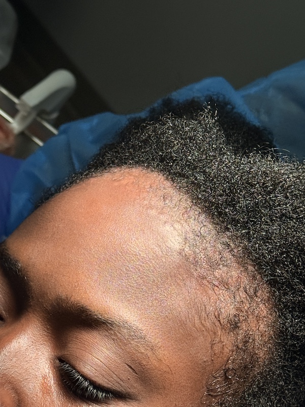 Women’s Hair Loss Clinic, Hair Loss Clinics Near Me, Hair Loss Clinic Naples, Hair Loss Clinic Fort Myers, , Hair Restoration Clinics in Naples, Hair Restoration Clinics in Fort Myers, Hair loss clinics near me, Women’s Hair Thinning Treatment, Doctors that treat thinning hair, Dermatologists that treat thinning hair, Hair Regrowth Clinics Near Me, Womens Hair growth Treatment, Doctors that restore hair growth, Hair Growth Clinics, women’s hair restoration, doctors that restore hair growth, doctors that specialize in hair restoration, non surgical hair restoration treatment, women’s hair restoration treatment, women’s hair restoration near me, Alopecia Dermatologist Near Me, Trichologist Near Me, Trichologist Naples Florida, Women’s Hair Restoration Clinics Near Me, Women’s Hair Restoration Near Me, Naples Hair Restoration, Fort Myers Hair Restoration, PRP Hair Restoration, prp for hair, PBC Hair Restoration, prp hair loss, PBC hair restoration treatment, platelet rich plasma for hair loss, prp hair loss treatment, Regenerative Hair Restoration, Regenerative Hair Growth, Regenerative Hair Regrowth, Naples Hair Loss Treatment, Fort Myers Hair Loss Treatment, Non-surgical hair loss treatment, Non-surgical hair growth treatment, Women’s hair growth treatment, Non-surgical hair regrowth treatment, Women’s hair regrowth treatment, Female hair growth treatment, Best hair growth treatment for women, hair thinning treatment for female, best treatment for hair growth, best non surgical hair loss treatment, Treating androgenic alopecia