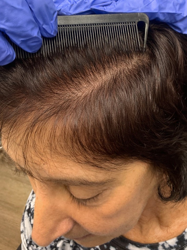women’s hair restoration, doctors that restore hair growth, doctors that specialize in hair restoration, non surgical hair restoration treatment, women’s hair restoration treatment, women’s hair restoration near me, Alopecia Dermatologist Near Me, Trichologist Near Me, Trichologist Naples Florida, Women’s Hair Restoration Clinics Near Me, Women’s Hair Restoration Near Me, Naples Hair Restoration, Fort Myers Hair Restoration