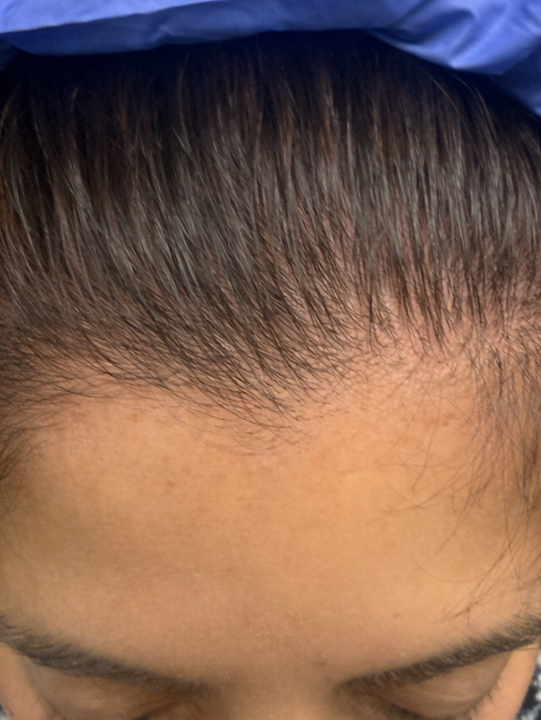 women’s hair restoration, doctors that restore hair growth, doctors that specialize in hair restoration, non surgical hair restoration treatment, women’s hair restoration treatment, women’s hair restoration near me, Alopecia Dermatologist Near Me, Trichologist Near Me, Trichologist Naples Florida, Women’s Hair Restoration Clinics Near Me, Women’s Hair Restoration Near Me, Naples Hair Restoration, Fort Myers Hair Restoration