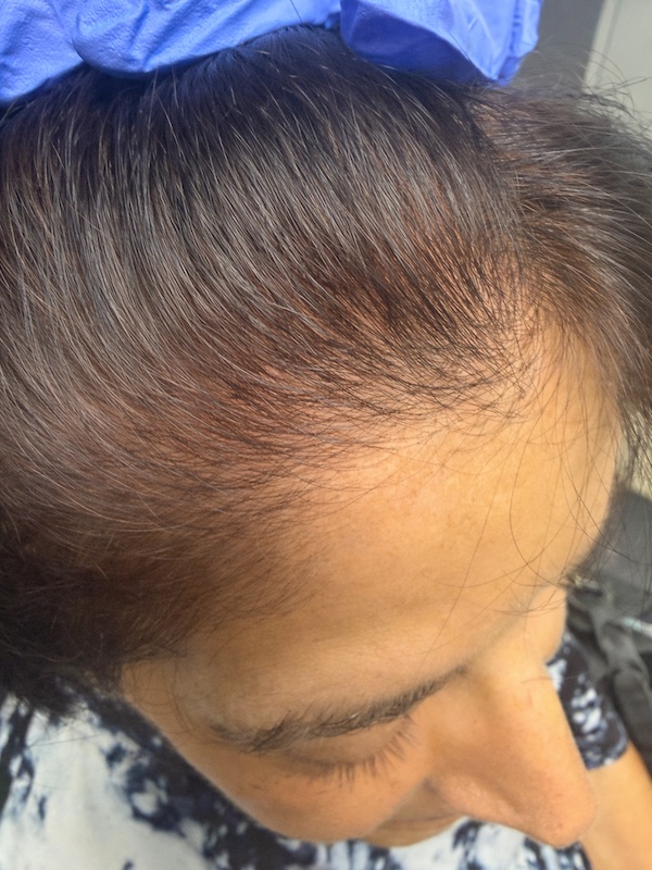 Women’s Hair Loss Clinic, Hair Loss Clinics Near Me, Hair Loss Clinic Naples, Hair Loss Clinic Fort Myers, , Hair Restoration Clinics in Naples, Hair Restoration Clinics in Fort Myers, Hair loss clinics near me, Women’s Hair Thinning Treatment, Doctors that treat thinning hair, Dermatologists that treat thinning hair, Hair Regrowth Clinics Near Me, Womens Hair growth Treatment, Doctors that restore hair growth, Hair Growth Clinics, women’s hair restoration, doctors that restore hair growth, doctors that specialize in hair restoration, non surgical hair restoration treatment, women’s hair restoration treatment, women’s hair restoration near me, Alopecia Dermatologist Near Me, Trichologist Near Me, Trichologist Naples Florida, Women’s Hair Restoration Clinics Near Me, Women’s Hair Restoration Near Me, Naples Hair Restoration, Fort Myers Hair Restoration, PRP Hair Restoration, prp for hair, PBC Hair Restoration, prp hair loss, PBC hair restoration treatment, platelet rich plasma for hair loss, prp hair loss treatment, Regenerative Hair Restoration, Regenerative Hair Growth, Regenerative Hair Regrowth, Naples Hair Loss Treatment, Fort Myers Hair Loss Treatment, Non-surgical hair loss treatment, Non-surgical hair growth treatment, Women’s hair growth treatment, Non-surgical hair regrowth treatment, Women’s hair regrowth treatment, Female hair growth treatment, Best hair growth treatment for women, hair thinning treatment for female, best treatment for hair growth, best non surgical hair loss treatment, Treating androgenic alopecia