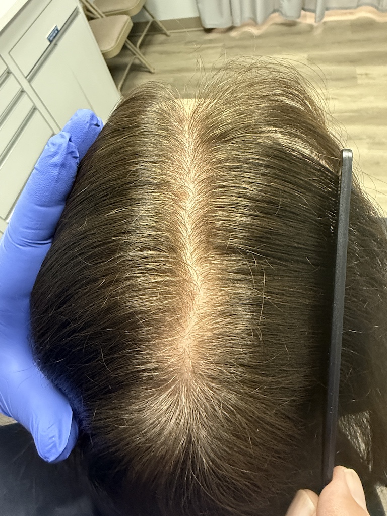 women’s hair thinning treatment, treating women’s thinning hair, doctors that treat thinning hair, women’s hair loss clinics, restoring hair growth, Restoring hair loss in women, restoring women’s hair loss