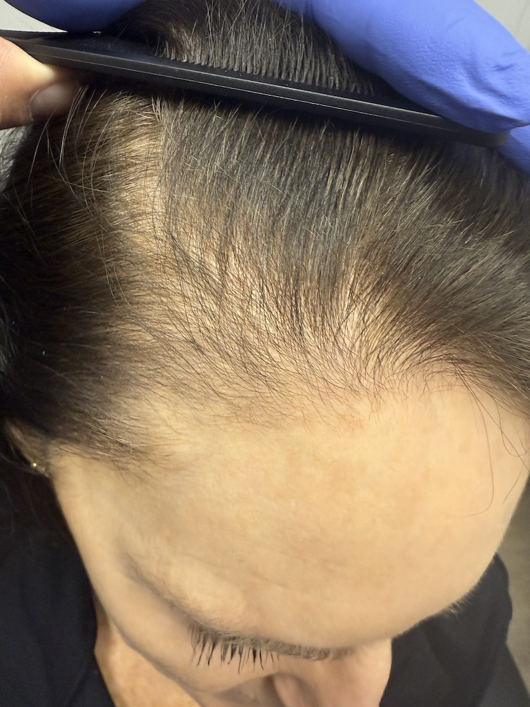 women’s hair thinning treatment, treating women’s thinning hair, doctors that treat thinning hair, women’s hair loss clinics, restoring hair growth, Restoring hair loss in women, restoring women’s hair loss